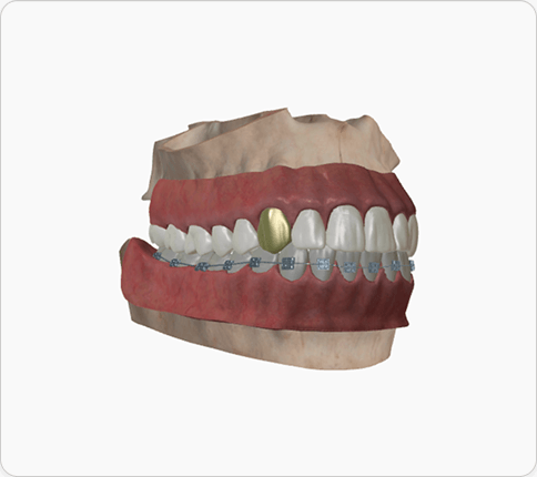 3D jaw with braces and a gold crown