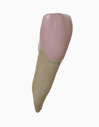 3D incisor with a filling