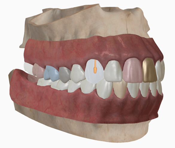 3D jaw with color-coded treatments